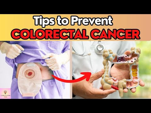 Tips to Prevent Colorectal Cancer | Colon Cancer | [Video]