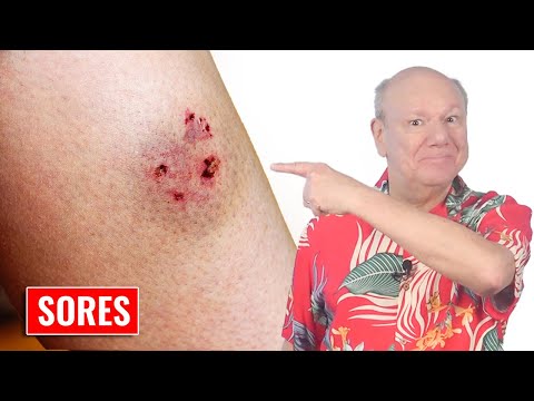 Acupressure Bliss: Banish Sores and Discomfort Today [Video]