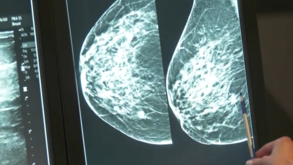 Strathmore gets visit from mobile mammography trailer [Video]