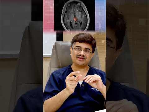 Metastatic Tumors of the Brain: Diagnosis and Treatment Dr.Roopesh Kumar Short 4 [Video]
