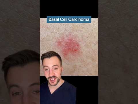 Basal Cell Carcinoma Expert Dermatologist Tips for Prevention and Treatment #Skin Cancer [Video]