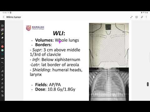 Radiation in Wilms Tumor: COG & SIOP protocols [Video]