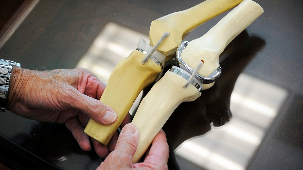 Sask. has longest wait times for knee, hip replacements in Canada, CIHI reports [Video]