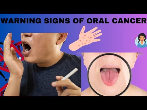 Warning Signs of Oral Cancer: Recognize the Early Symptoms [Video]