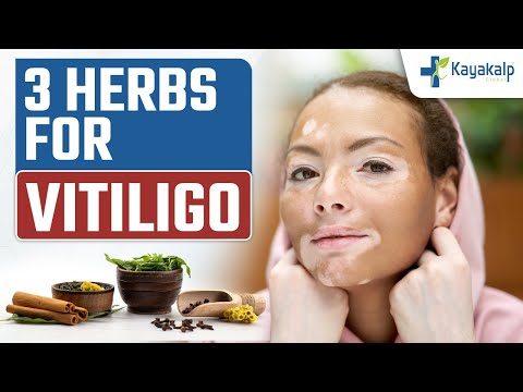 3 Best Herbs for Vitiligo | Home Remedies for Vitiligo  Relief | Kayakalp Global [Video]