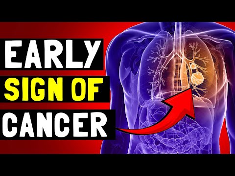 12 Early Signs of Cancer to Watch Out For [Video]