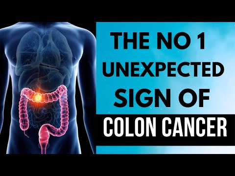 THE NO 1 UNEXPECTED SIGN OF COLON CANCER [Video]