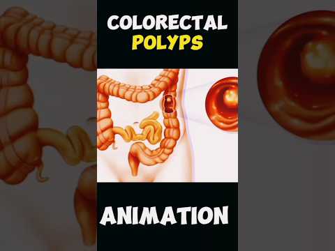 colonoscopy procedure for removing colon polyps [Video]