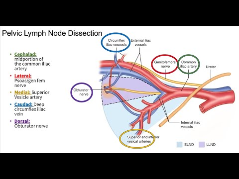Pelvic and Paraaortic Lymph Node Dissection: Gynecologic Cancer [Video]