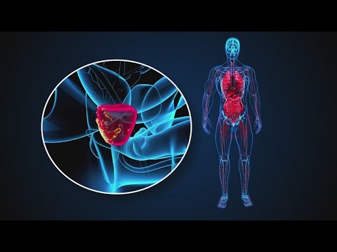 Prostate cancer rates in African-American men [Video]