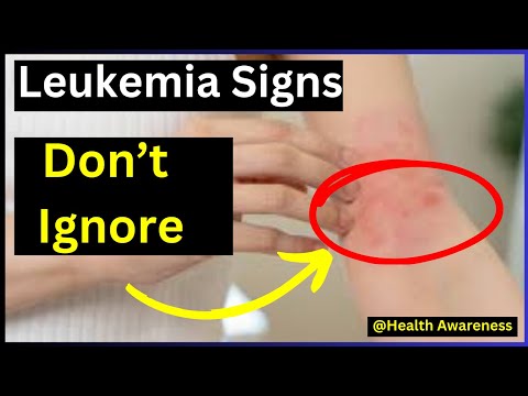 8 Early Warning Signs And Symptoms of Leukemia You Should Know. [Video]