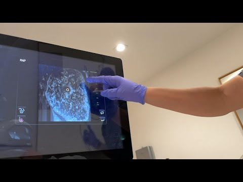 SF ultrasound clinic using FDA-approved AI to help detect types of breast cancer faster [Video]