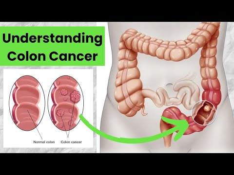 Understanding Colon Cancer: Causes, Symptoms & Treatment Options I OnlyMyHealth [Video]