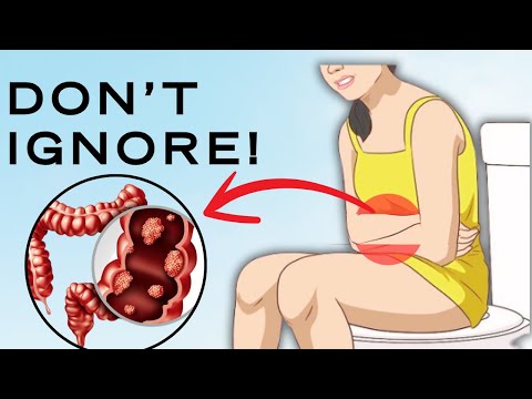 critical colon cancer symptoms you should never ignore [Video]