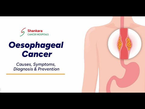 Everything you need to know about Oesophageal Cancer | Dr. Saroj Ranjan Sahoo & Dr. Rupak Kumar Giri [Video]