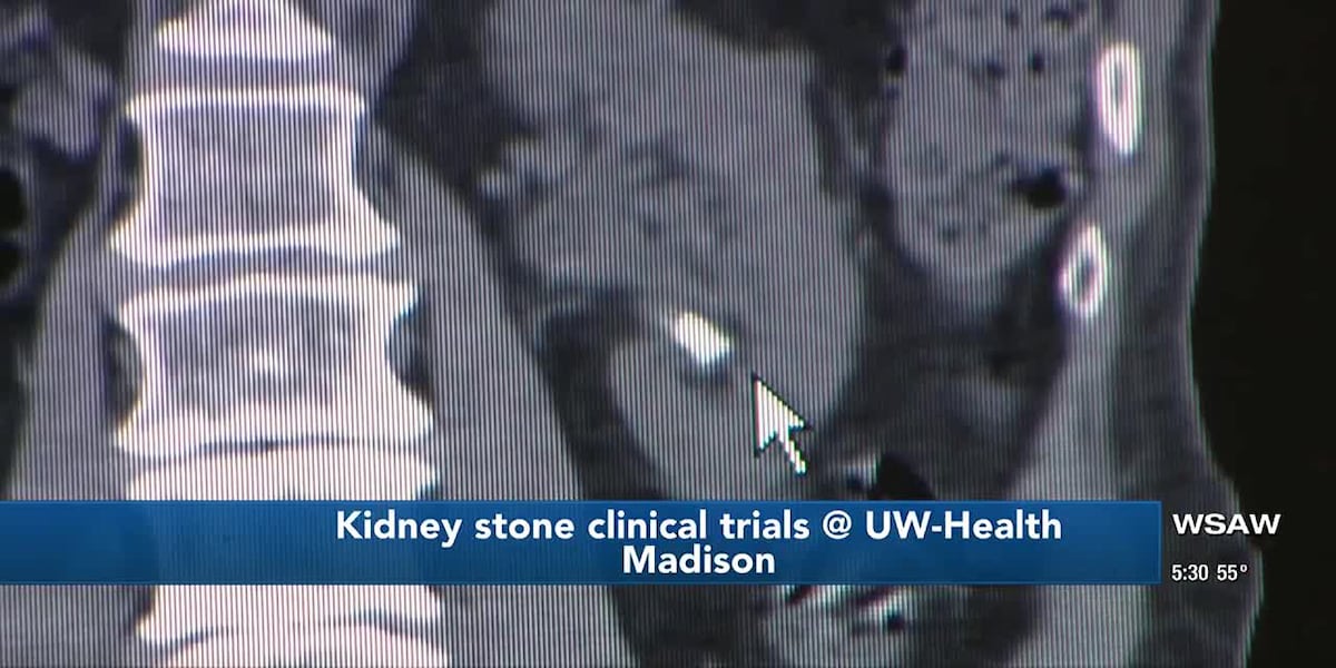 Kidney stone clinical trials @ UW-Health [Video]
