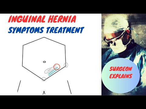 Inguinal Hernia Symptoms and Treatment [Video]
