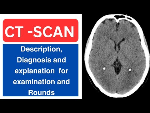 CT SCAN BRAIN – Diagnosis, description, and explanation for examination and ward Rounds [Video]