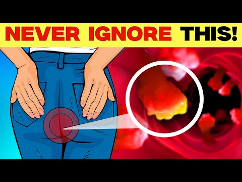 10 Colon Cancer Symptoms You Can’t Ignore! [Video]