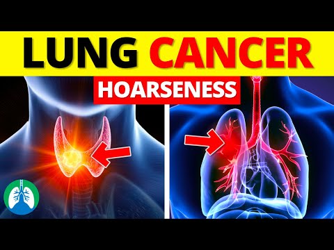 Is Hoarseness a Sign of Lung Cancer ❓ [Video]