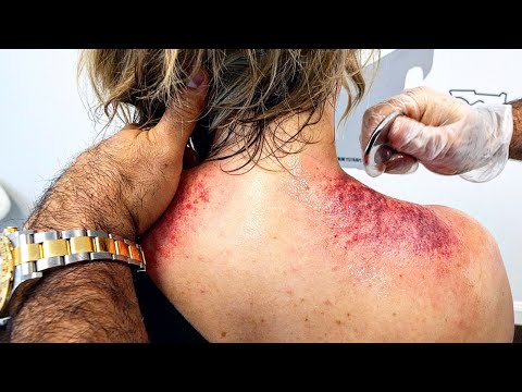 Extreme Muscle Scraping & Chiropractic Cracking *EMOTIONAL RELEASE* [Video]