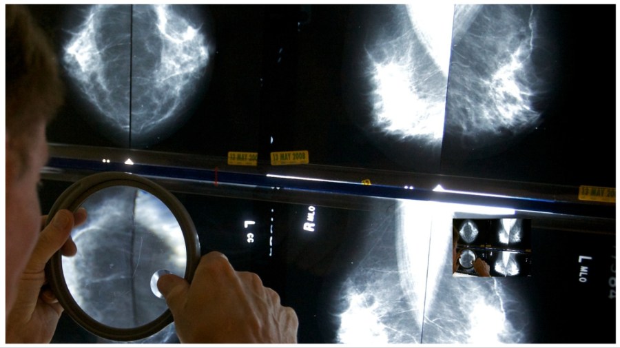 Mammogram guidance changing amid younger and younger breast cancer diagnoses [Video]