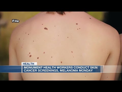 Monument Health volunteers conduct skin cancer screenings as part of Melanoma Monday [Video]