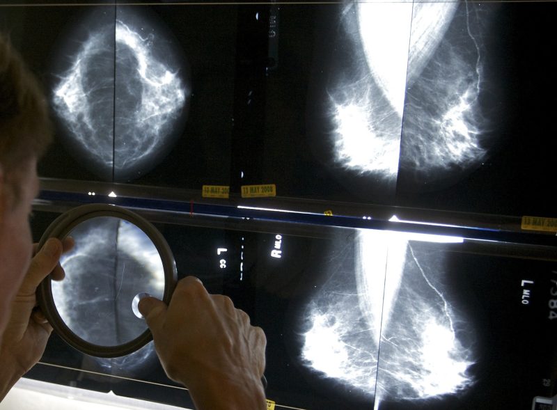Mammograms should start earlier amid rising breast cancer rates, panel says [Video]