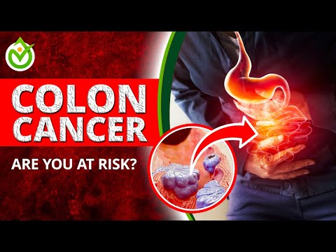 🤔 Are You at Risk? Colon Cancer Signs & Solutions! 💪 [Video]