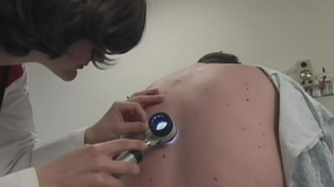 Melanoma Monday: New hope for those with an advanced form of the disease [Video]