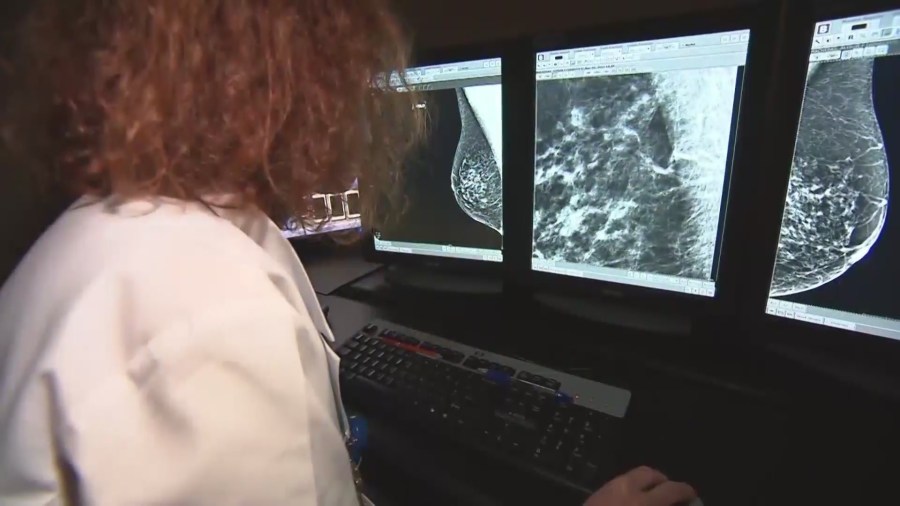 Women should have mammograms earlier in life, experts say [Video]