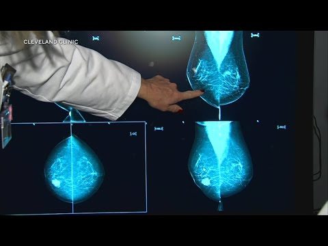 Young women are being diagnosed with breast cancer, here is what doctors say [Video]