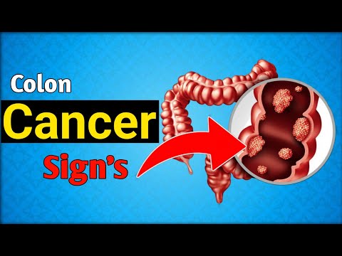8 Worst Daily Habits to Cause POLYPS and COLON CANCER [Video]