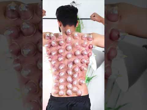 #cupping [Video]