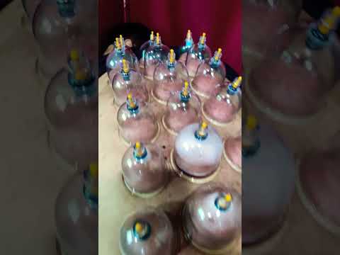 Cupping Therapy for Back Pain [Video]