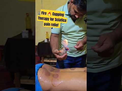 #fire #chiropractic #shortfeed #trending #subscribe #sports #treatment #cupping_therapy [Video]