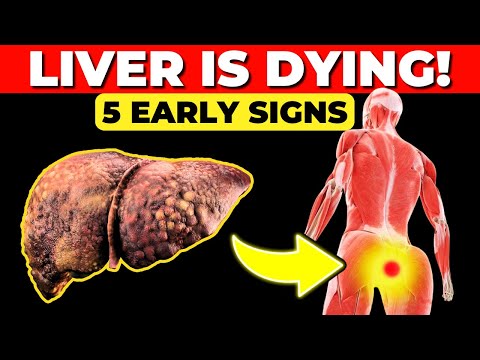 LIVER is DYING! 5 Weird Signs of LIVER DISEASE [Video]