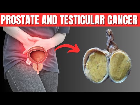 Prostate And Testicular Cancer | Physio Speaks [Video]