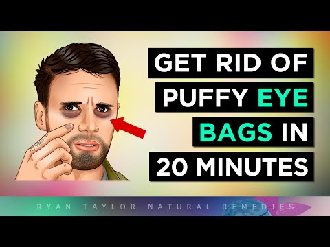 Get RID of Puffy Eyes Instantly (Natural Remedies) [Video]