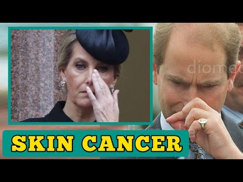 SKIN CANCER!🛑 Prince Edward shed tears as Doctors reveal Sophie has severe Skin Cancer [Video]