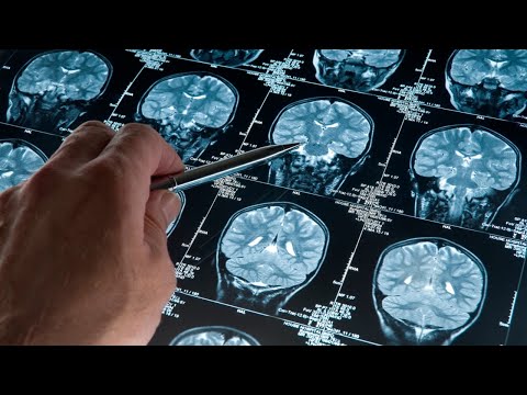 May marks Brain Tumour Awareness Month [Video]