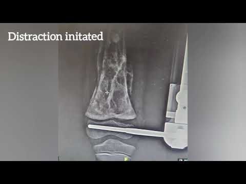 PHYSEAL SEPARATION OF DISTAL FEMUR IN A KID DIAGNOSED WITH OSTEOSARCOMA OF DISTAL FEMUR. [Video]