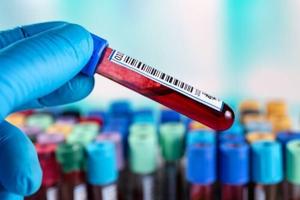 New Blood Test Could Spot Dangerous Type of Stroke [Video]