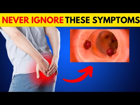 Deadly Colon Cancer Symptoms You Should Never Ignore [Video]