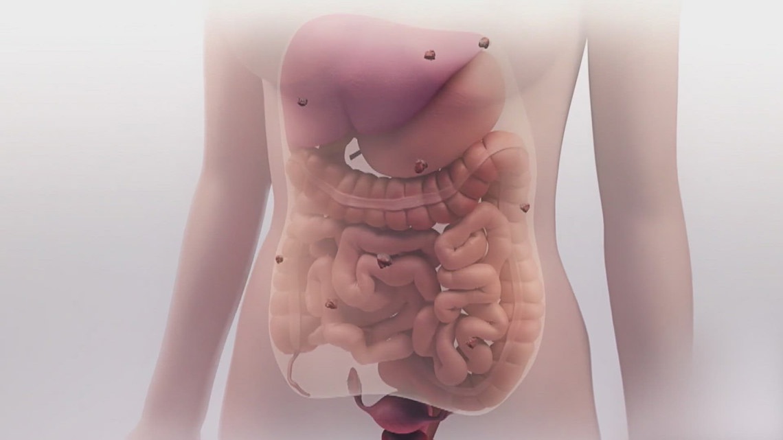 New chemotherapy approach for stomach cancer [Video]