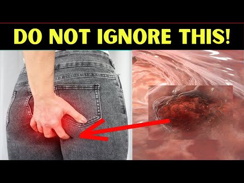 7 Warning Signs of Colon Cancer You Should NEVER Ignore [Video]