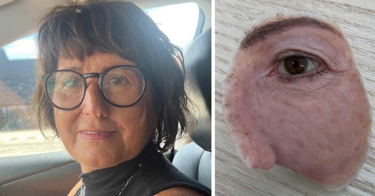 Tracey lost her eye to cancer, but her prosthesis was considered ‘cosmetic’ [Video]