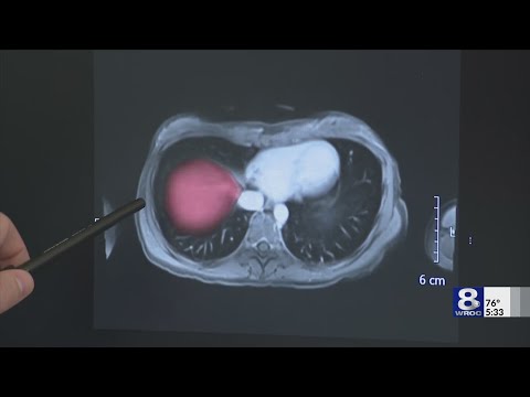 Colorectal cancer survivor credits URMC for rare living donor transplant [Video]