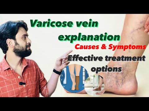 Understanding varicose veins: Causes, symptoms and treatment options [Video]