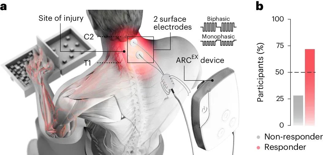 New Device Delivers Electric Pulses to Help Patients Regain Movement After Spinal Cord Injuries [Video]